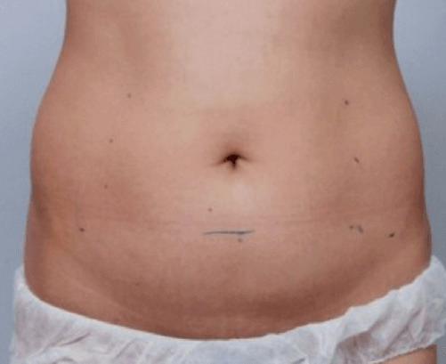 Antes de Ultraformer 3