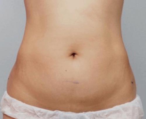 Después de Ultraformer 3