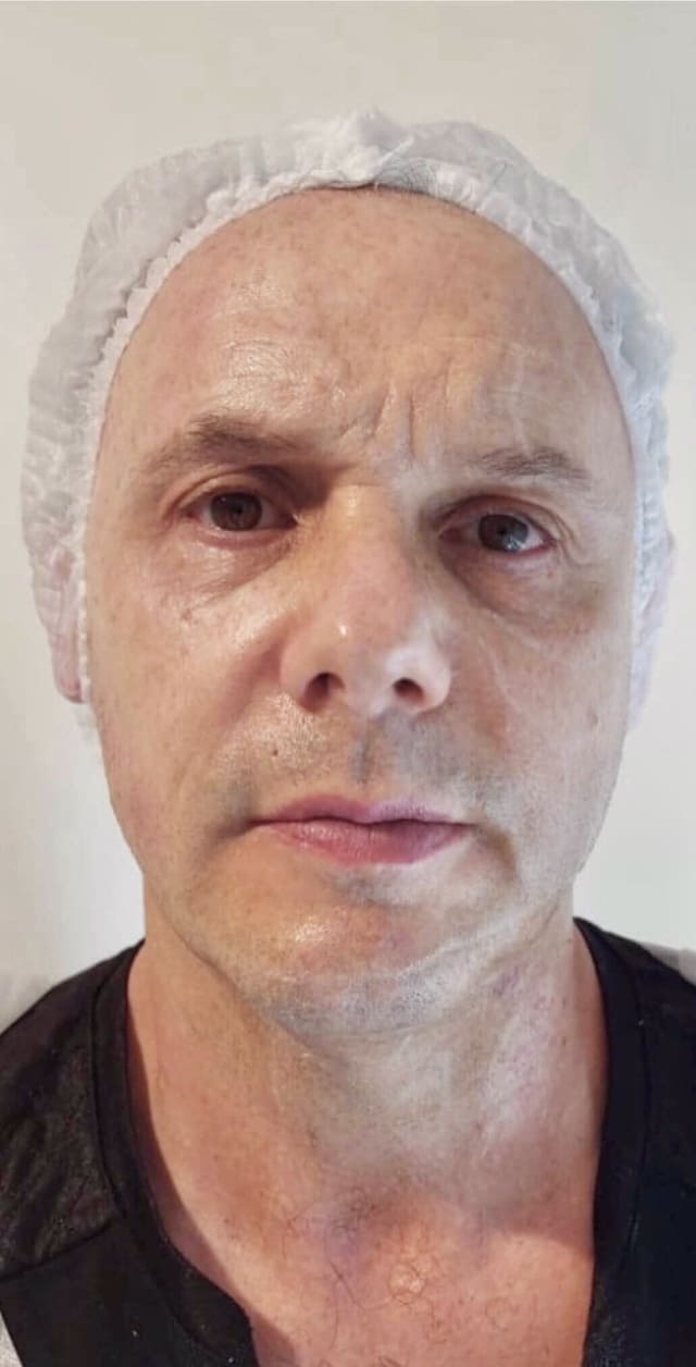 Antes de Ultraformer 3