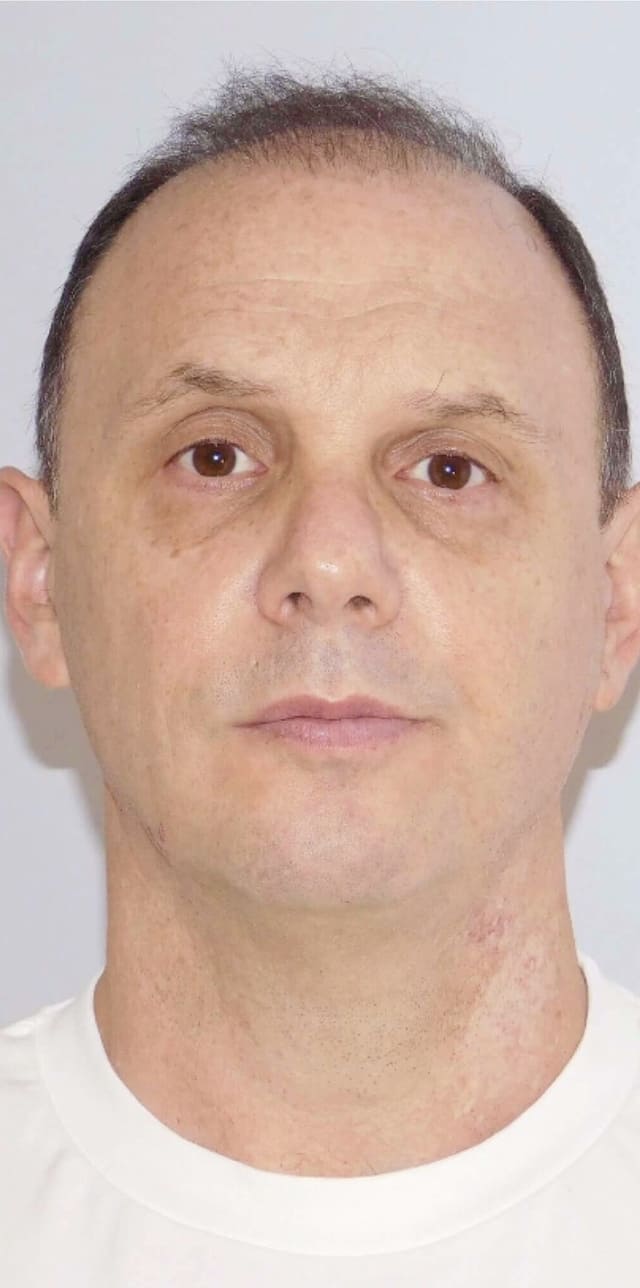 Después de Ultraformer 3